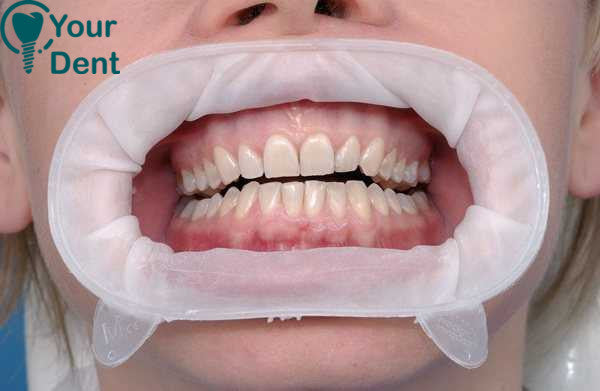 10 Soft Lip And Cheek Retractor Optragate Small - פותח פה גמיש קטן 10 יח
